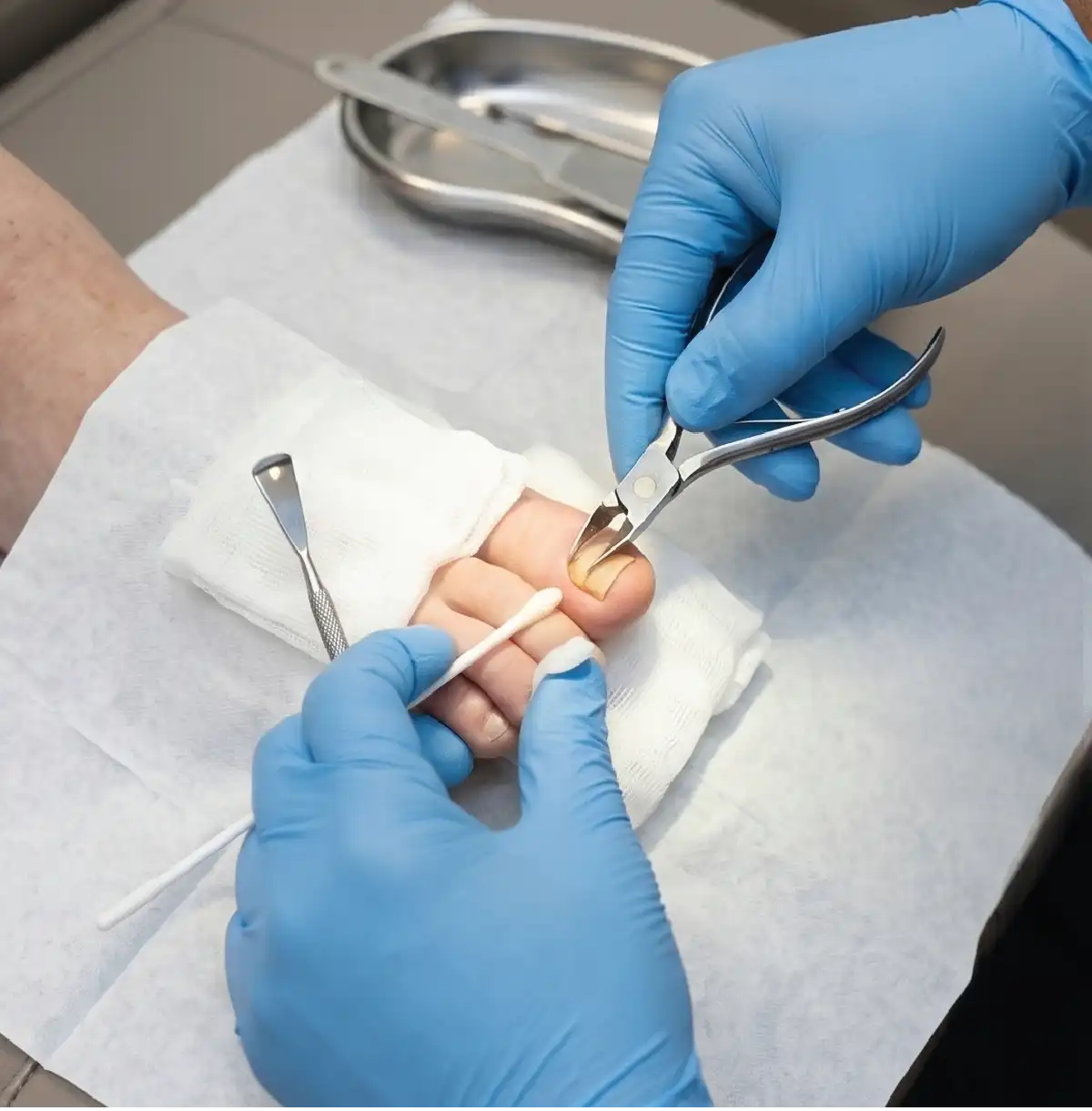 Minor nail surgery procedure